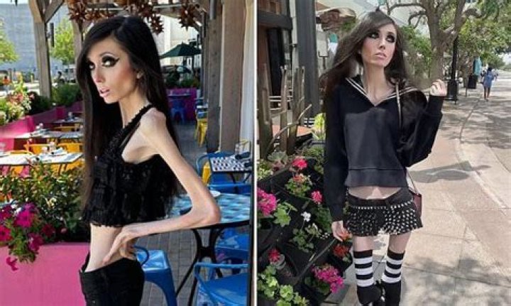 Anorexic Woman Canada: Who Is Lisa Pauli? Why Is She Pleading For Death?