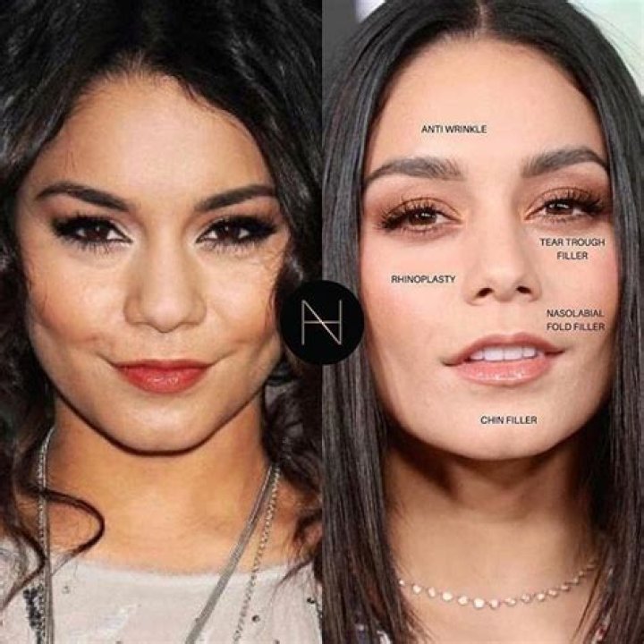 Vanessa Hudgens Botox: Before And After Photos 2023